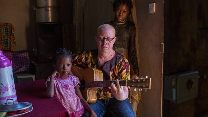 Cómo viven los albinos en Mozambique